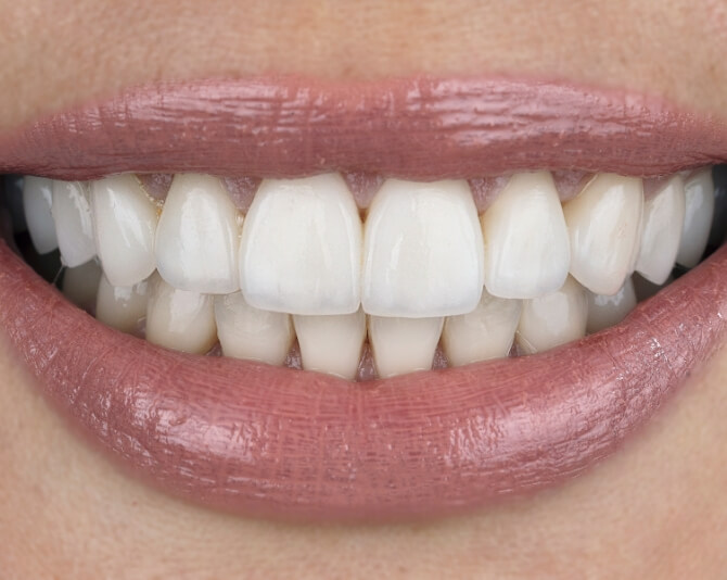 Metal free dental crown restoration options