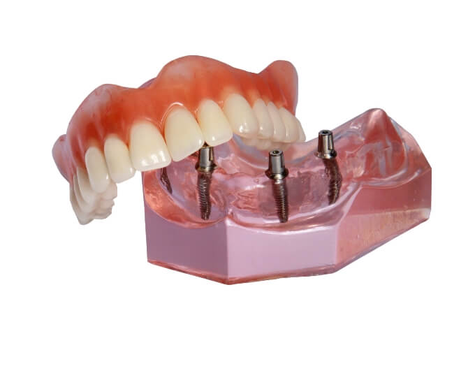 Illustration of implant dentures in Edison, NJ for lower arch