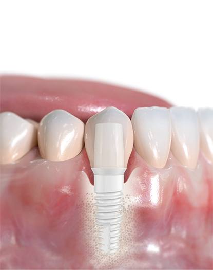 Model smile with zirconia dental implant supported dental crown