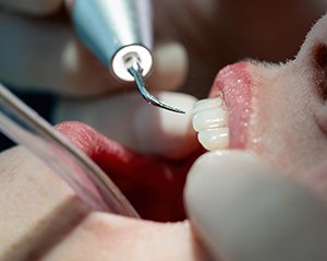 Scaling and root planing is typically done in two appointments