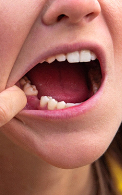 Woman with a missing tooth