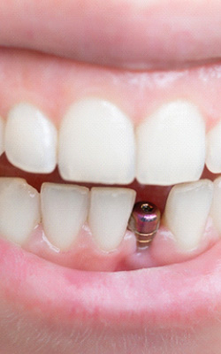 Closeup of a dental implant