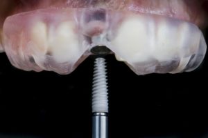 Implant being placed during guided dental implant surgery