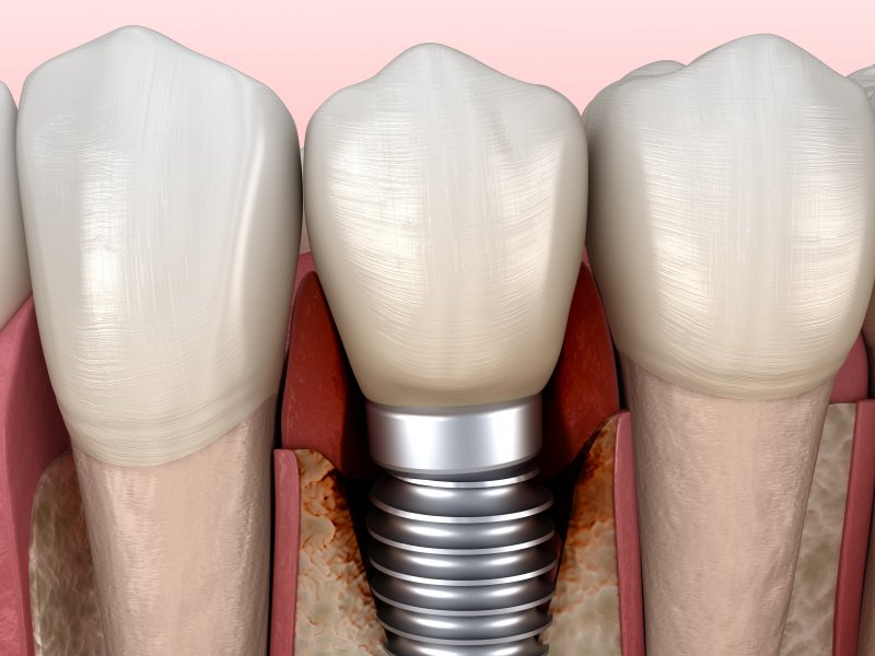 a failed dental implant