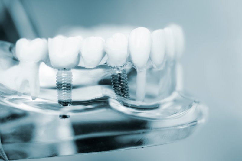 Close-up of dental implants