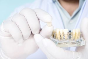 Dentist holding sample dental implant with white gloves