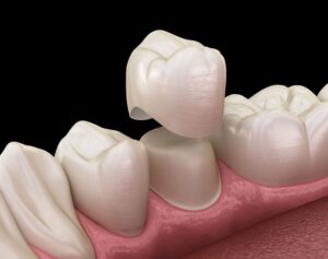 Illustration showing a dental crown above the abutment tooth