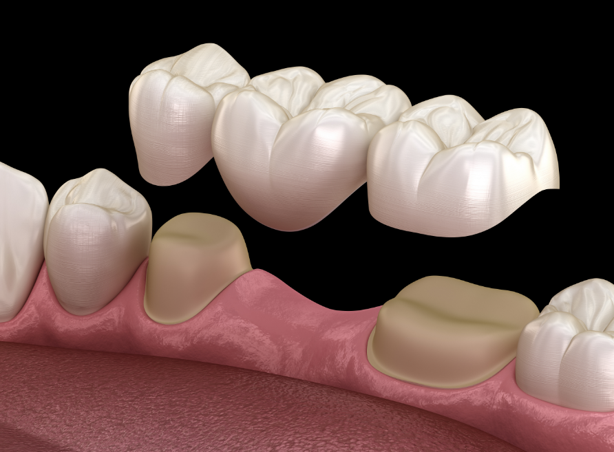 3D image of a dental bridge