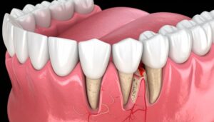 Illustration showing advanced periodontal pockets